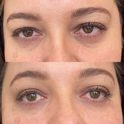 Cheek and Under Eyes Filler Results 1