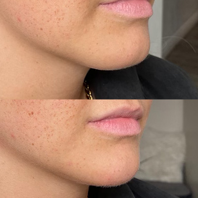 Chin Augmentation Services Results 2