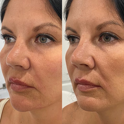 Chin Augmentation Services Results 3
