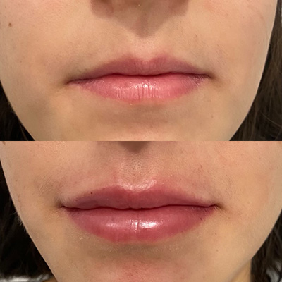 Lip Filler Service Results for plumping thin lips