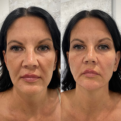 Lower Face Filler Before and After