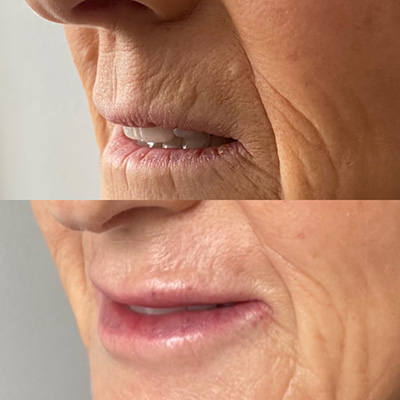 Lower Face Filler Before and After 2