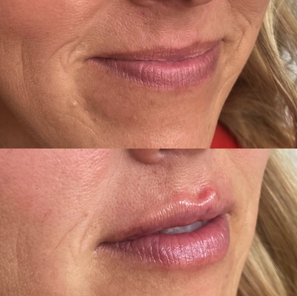 Before and After Lip Filler Treatments for volume